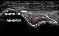 川越市 高校生 肘関節の痛み 肘の捻挫 内側側副靭帯 ふじみ接骨院