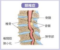 坂戸市 男性会社員 首の痛み 首肩こりが酷いんです 頸椎症 ふじみ接骨院