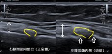 坂戸市 主婦 左膝関節の痛み 捻挫 変形性膝関節症 ふじみ接骨院