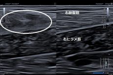 川越市 男性会社員 肉離れやっちゃったかも 左腓腹筋の肉離れ ふじみ接骨院